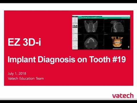 Implant Diagnosis (19 Implant Case)